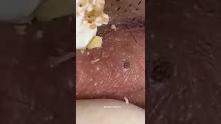 Blackheads Removal  Acne Treatment and Very Satisfying Satisfying Pimple pop blackheads [upl. by Ahtera]