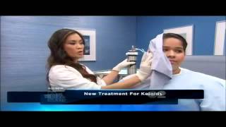 Keloid amp Hypertrophic Scar treatment using Cryoshape on quotThe Doctors TVquot [upl. by Lacie]