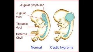 Applied anatomy of posterior triangle of the neck  Troisers sign  Cystic hygroma  Cystic lymphan [upl. by Kilah]