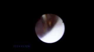 Ureterorenoscopy and removal of kidney stone [upl. by Garibald245]