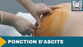 PONCTION DASCITE [upl. by Donnenfeld]