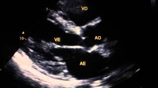 Disfuncao ventricular moderada  fe 40 [upl. by Etteniuq]