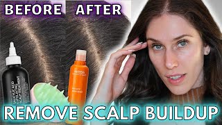 🧀 How I Got Rid Of Scalp Buildup  How To Remove Scalp Buildup amp Scalp Exfoliation Favorites [upl. by Ardnasella330]