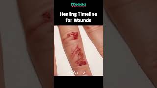 Wound Healing Explained Stages Factors and Tips for Recovery [upl. by Nanon]