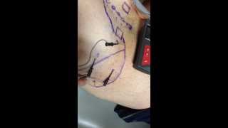 Electrical Dry Needling to Trigger Points in the Gluteus Medius and Minimus Muscles [upl. by Genisia861]