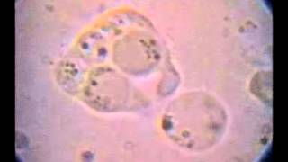 T hominis con 5 Blastocystis fagocitados intento de fagocitosis de otro y expulsión de uno [upl. by Epifano]