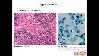 Difference BW Hyperparathyroidism and Hypoparathyroidism Endo pathology video part5 USMLE First Aid [upl. by Anaud]