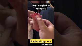 Babinski sign pediatrics neurology medico [upl. by Poul]