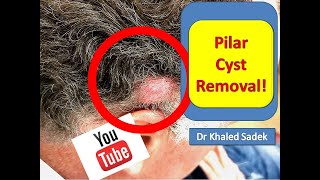 Large Pilar Cyst Removal LipomaCystcom Dr Khaled Sadek [upl. by Norvin]