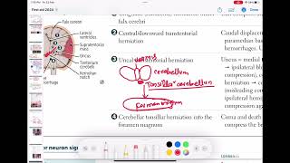 cerebellar tonsillar herniation neurology 151  First Aid USMLE Step 1 in UrduHindi [upl. by Tavie]