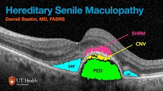 Macular Degeneration HSM 2024 [upl. by Yerfej]