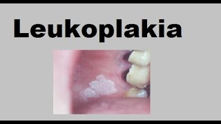 Leukoplakia [upl. by Dallman]