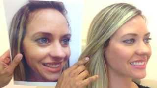 Botox amp Restylane Before amp After [upl. by Cassandre568]