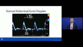 Coarctation of the AortaImaging and Management [upl. by Airan]