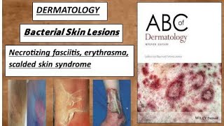 DERMATOLOGY Bacterial skin lesions  Necrotizing fasciitis erythrasma amp SSS derma bacteria [upl. by Rosaleen]