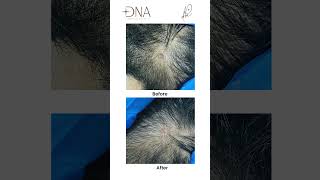 Warts Removal 🧏‍♀️ by RF Cautery  Skin Mole  Dr Priyanka Reddy  DNA Skin Clinic  shorts [upl. by Auston]