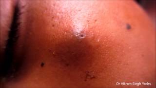 Big Infected Sebaceous Cyst Face [upl. by Esac]