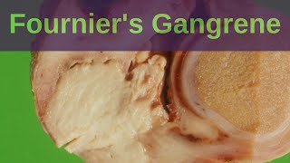 What is Fourniers Gangrene  Pathology mini tutorial [upl. by Ahsinet]