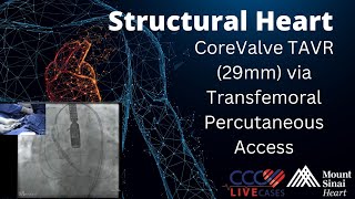 CoreValve TAVR 29mm via Transfemoral Percutaneous Access  February 2015 Structural Live Case [upl. by Ahasuerus]