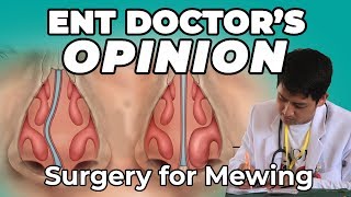 Turbinate Reduction Vs Deviated Septum Surgery For Mewing  ENT Doctor’s Opinion [upl. by Hgielak354]