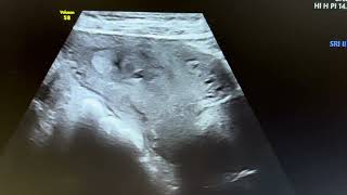 Ultrasound of cornual pregnancy [upl. by Refinney]