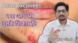 Acne excoriée  चेहरे पर pimples  क्या आप भी इसके शिकार हैं Acne Pigmentation face acnetreatment [upl. by Dugaid]