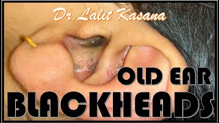 OLD EAR COMEDONES REMOVAL by Dr Lalit Kasana [upl. by Anid]