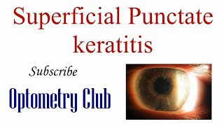 Superficial Punctate Keratitis Introduction Diagnosis and Treatment [upl. by Etoile174]