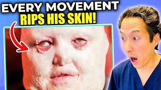 Plastic Surgeon Reacts to Man Whose Skin Falls Apart EXTREME Bodies Explained [upl. by Ciccia6]