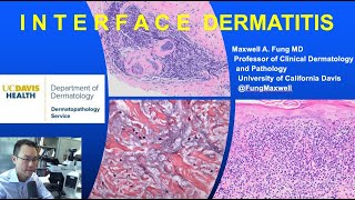 DERMATOPATHOLOGY Interface Dermatitis [upl. by Poirer371]