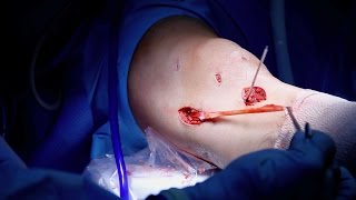 MCL Reconstruction Surgery [upl. by Hanschen]