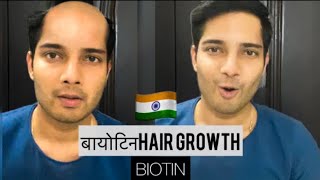 बायोटिन BIOTIN hair growth results before and after Hair growth HAIRFALL REMEDY hairloss Hindi [upl. by Holmun]