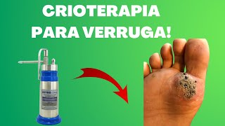 Como tratar verruga viral HPV com crioterapia  Você sabe o que é [upl. by Vinia163]