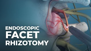 What is Endoscopic Facet Rhizotomy  AtlanticSpineCenter [upl. by Nylessej]