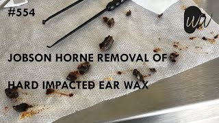 554  Jobson Horne Removal of Hard Impacted Ear Wax [upl. by Ysak]