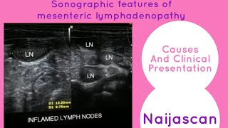 Abdominal Ultrasound  Mesenteric adenitis  Mesenteric lymphadenopathy  Abdominal pain in children [upl. by Ciro]