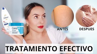 PIEL DE GALLINA Queratosis Pilaris COMO ELIMINARLA Karomakeup [upl. by Iormina]