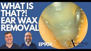 WHAT IS THAT EAR WAX REMOVAL  EP904 [upl. by Harding]