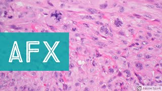 Atypical fibroxanthoma AFX vs mimics spindle cell melanoma squamous cell carcinoma etc [upl. by Murton564]