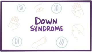 Down syndrome trisomy 21  causes symptoms diagnosis amp pathology [upl. by Tnecniv]