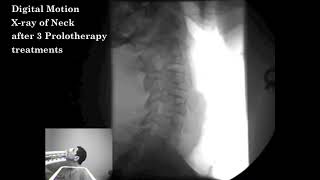 Digital Motion Xray before and after Prolotherapy [upl. by Ilatan]