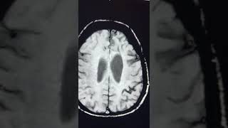 Significance of SWI  Superficial siderosis [upl. by Gasperoni]