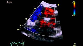 Patent Foramen Ovale  Transthoracic Echocardiogram TTE [upl. by Akinam]