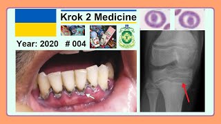 Krok 2 Medicine  Year 2020  004 Ministry of Public Health of Ukraine [upl. by Kreindler899]