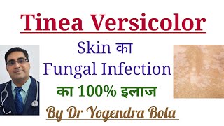 Tinea Versicolor Skin Infection ka 100 Treatment [upl. by Osterhus]