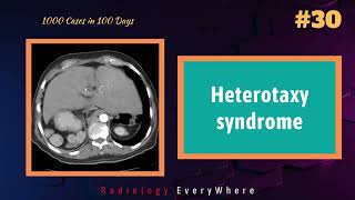 Heterotaxy Syndrome Radiology Tutorial  1000 cases in 100 Days  Video 30 [upl. by Eniac]