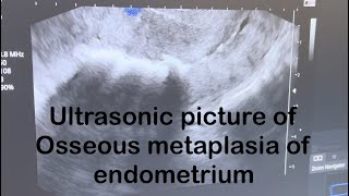 Ultrasound picture of Osseous metaplasia of endometrium [upl. by Hobey316]