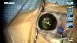 HD Surgery for visual axis opacification [upl. by Orly]