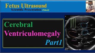 Fetus Ultrasound Cerebral Ventriculomegaly Part1 [upl. by Annoik294]