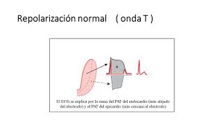 como interpretar el electrocardiograma en Isquemia miocárdica e infarto de miocardio Clase dos [upl. by Kirtap]